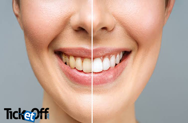 Blanqueamiento dental en consultorio